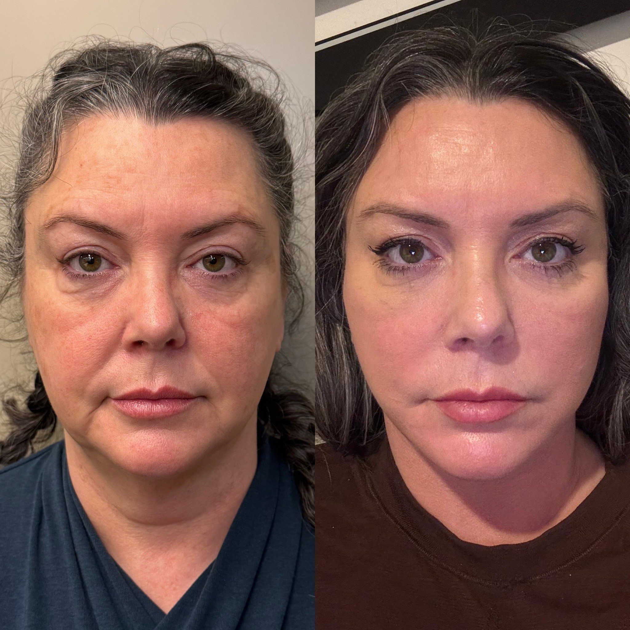 3 weeks before after photos of deep plane face neck lift patient front view