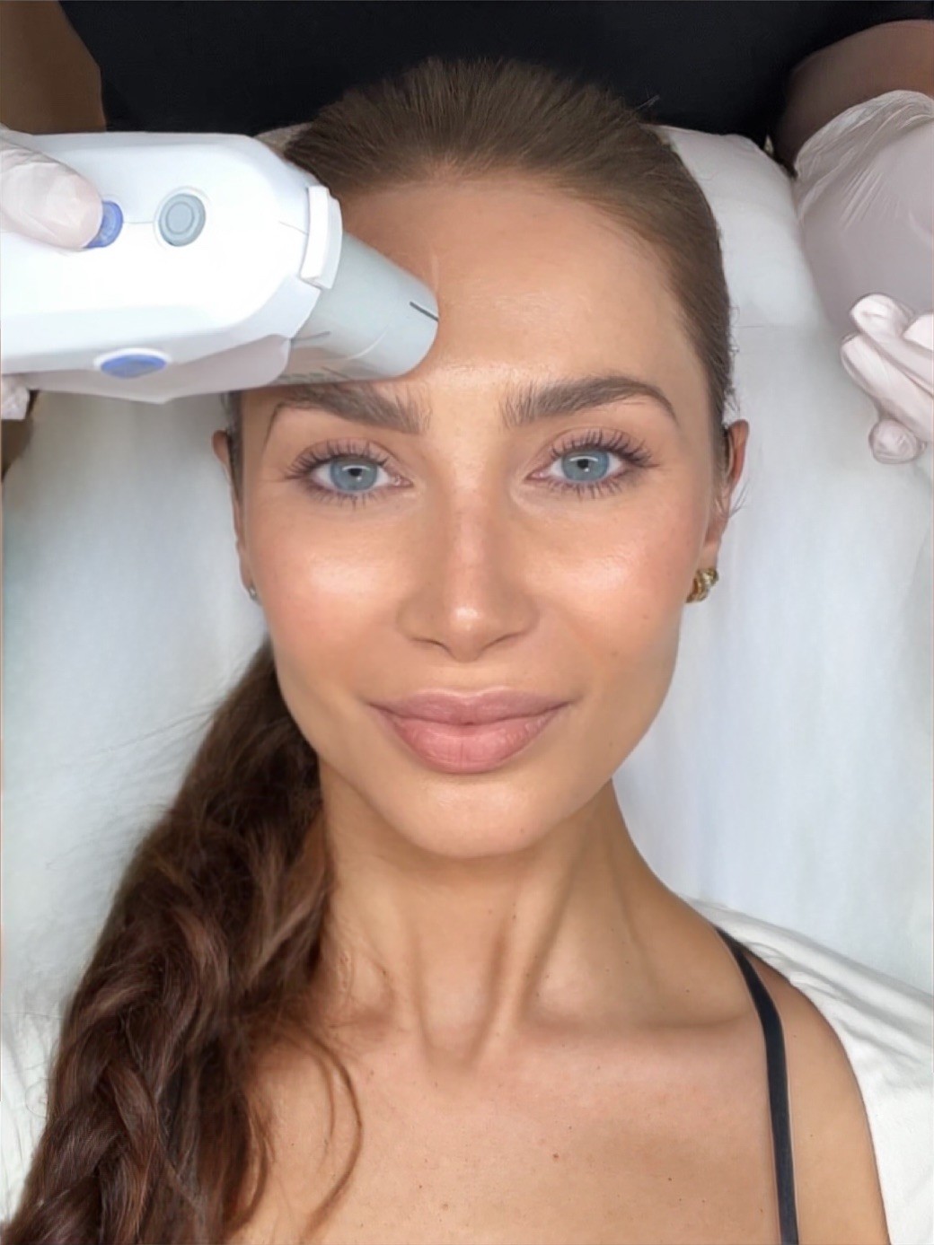 Ultherapy Prime