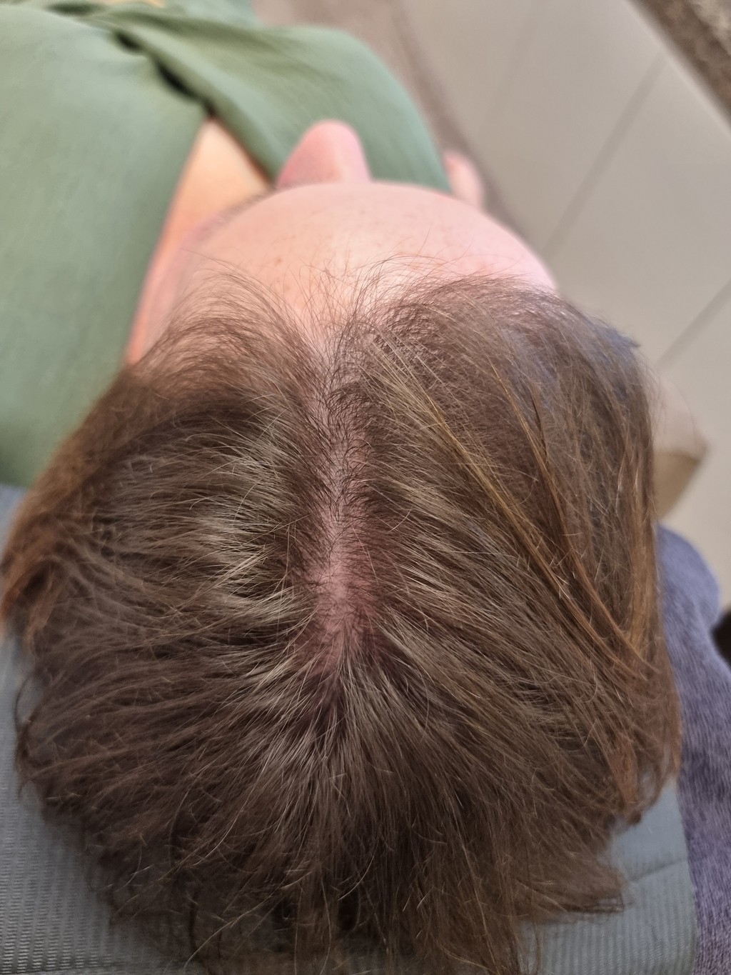 Micro haar pigmentatie Alluris