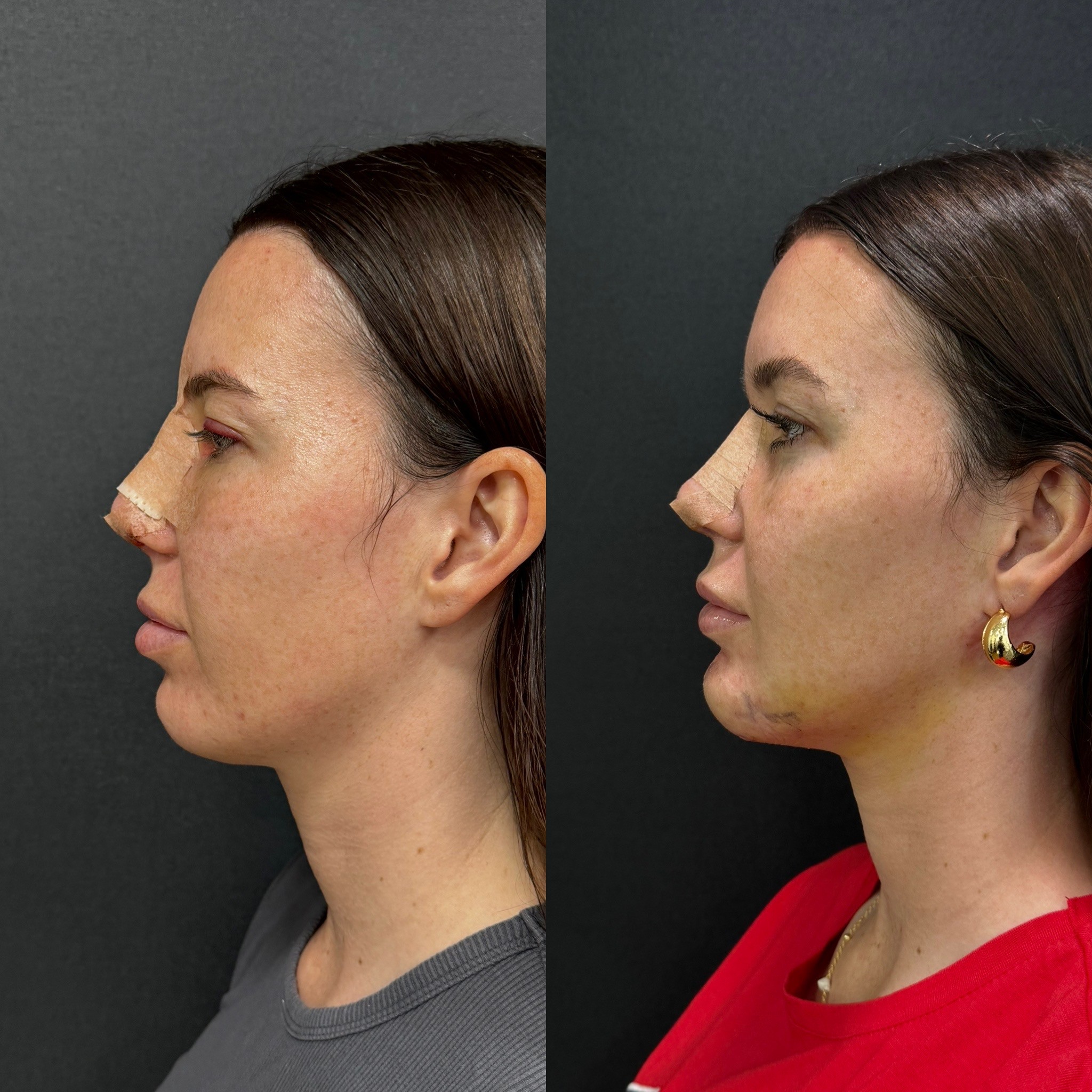 chin implant before after 5 days post-op