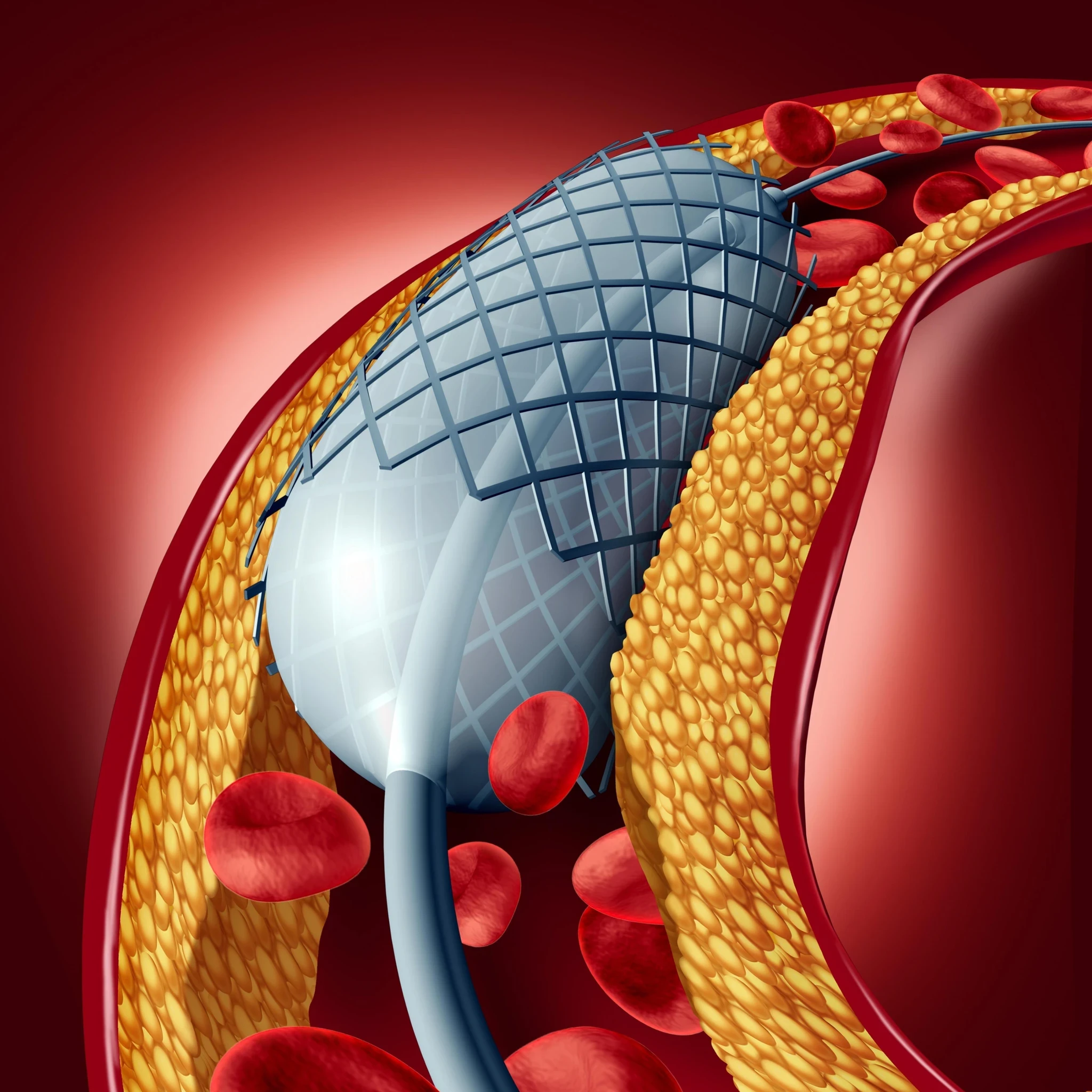 Angioplasty