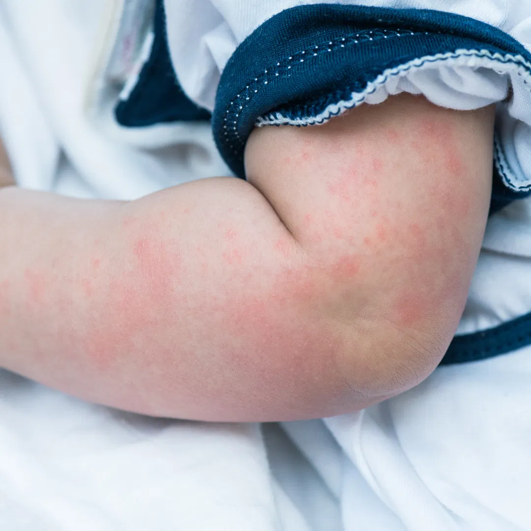 child with eczema on arm