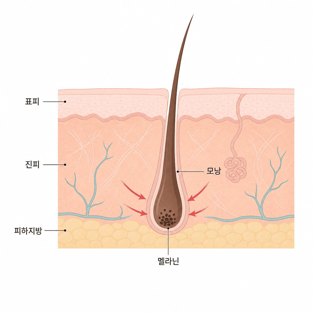모낭 깊숙한 멜라닌에 레이저 열이 전달되는 단면