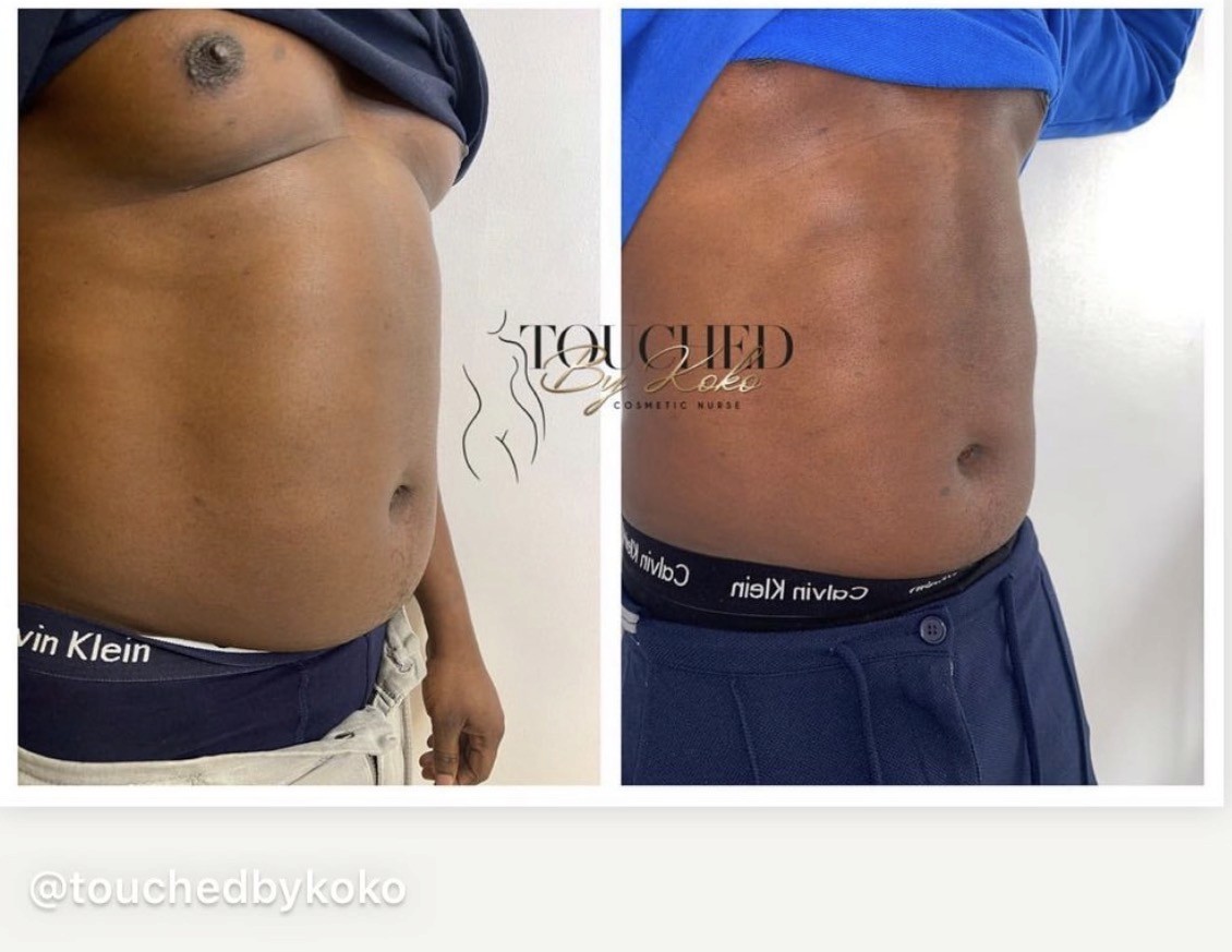 Fat dissolving male