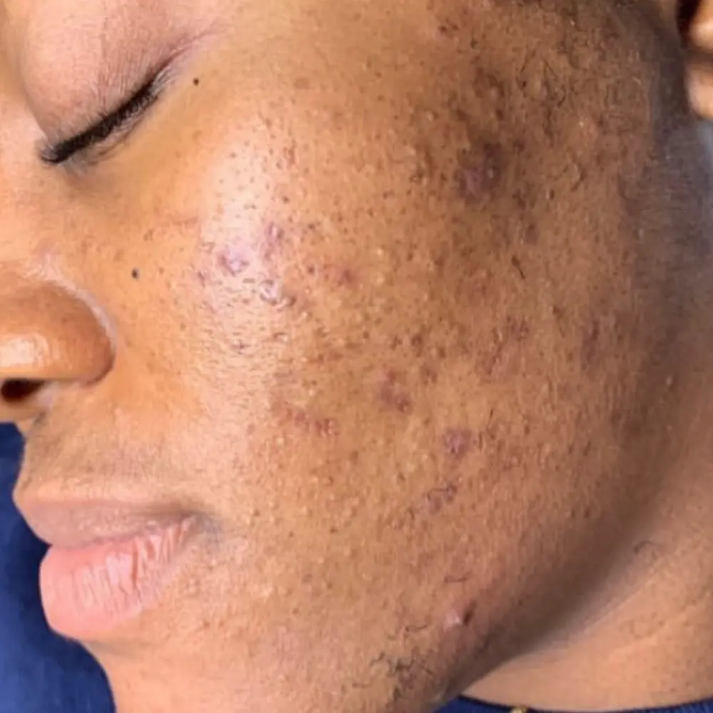 After vitamin C enzyme facial at The Vancouver Aesthetician — acne visibly improved and pigmentation noticeably reduced on melanin-rich skin