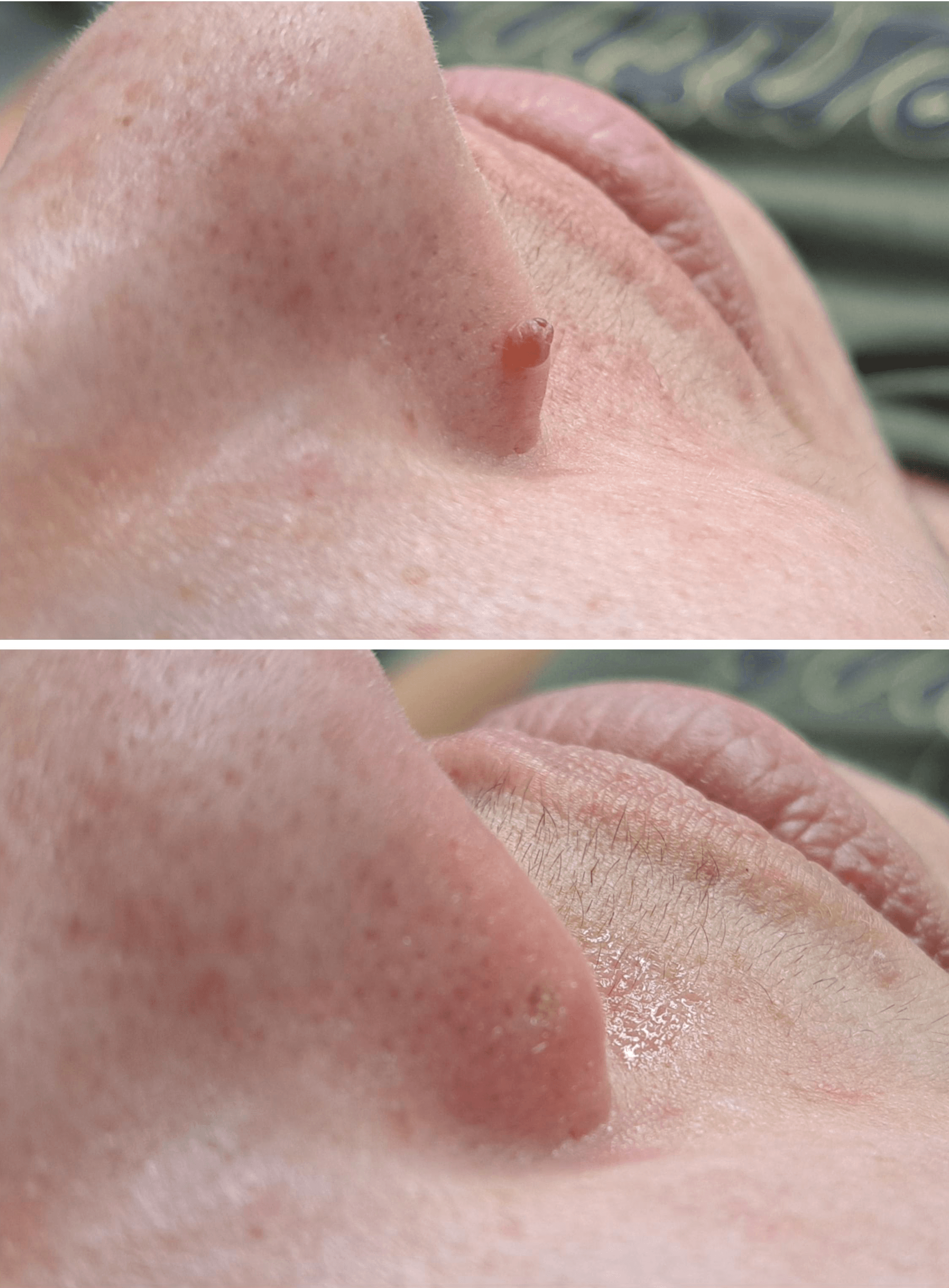 Skin tag removal before and after on nose