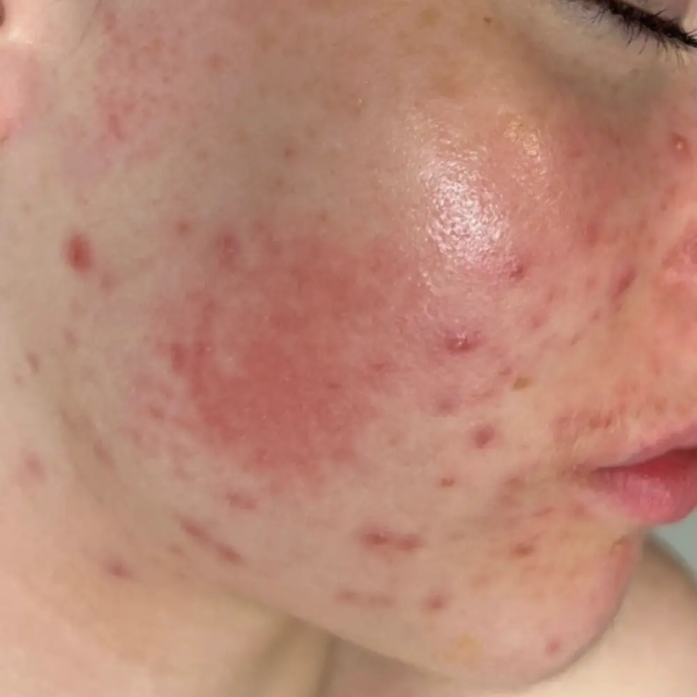 Before redness and rosacea treatment at The Vancouver Aesthetician — visible rosacea and facial redness causing significant skin irritation and uneven tone
