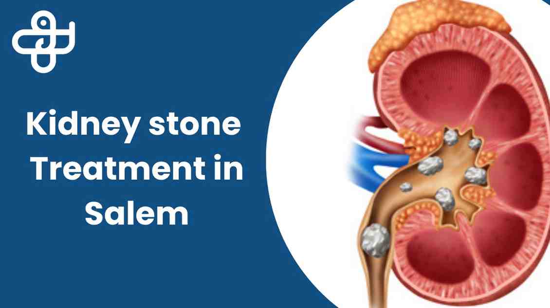 Advanced Kidney Stone
