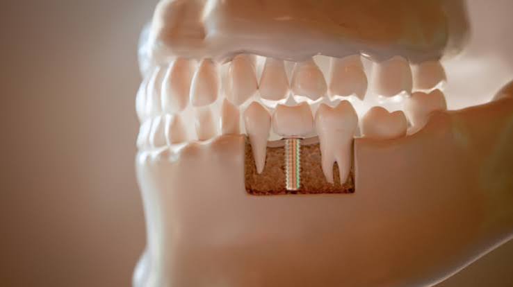 Patient placing a clear dental aligner over her teeth