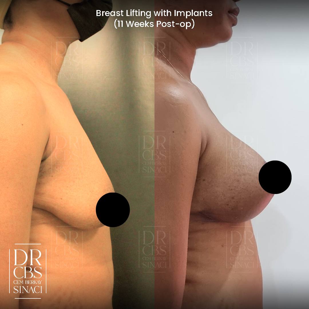 breast lift with implant mastopexy augmentation before after side view