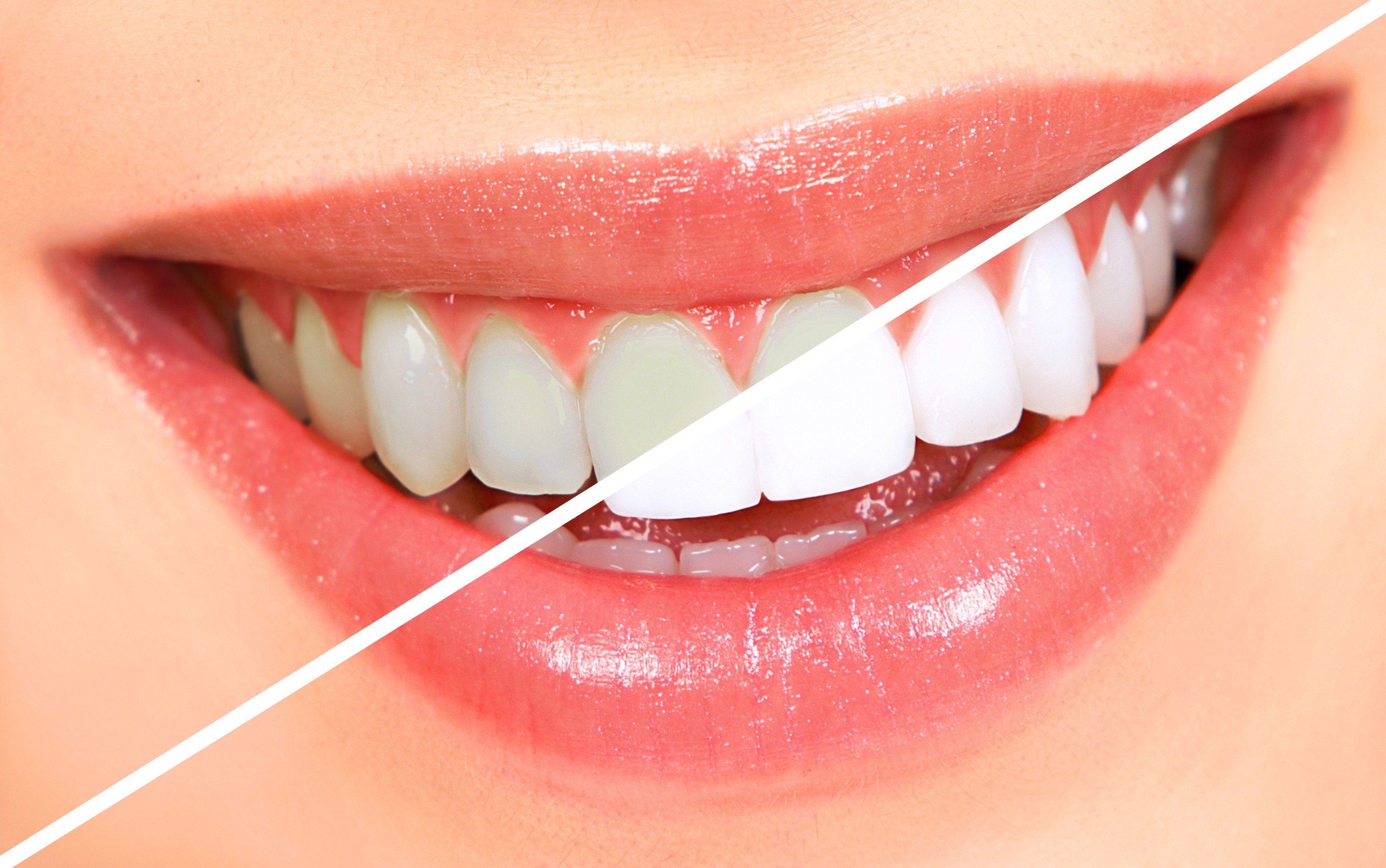 dental veneers