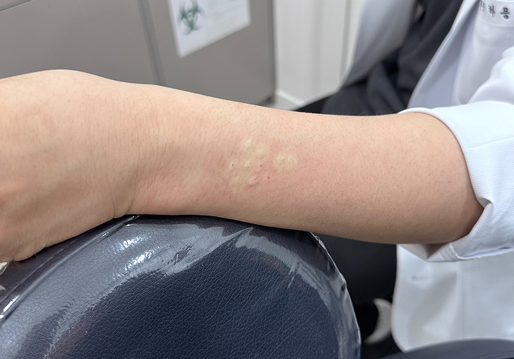 Forearm showing skin allergy test reaction