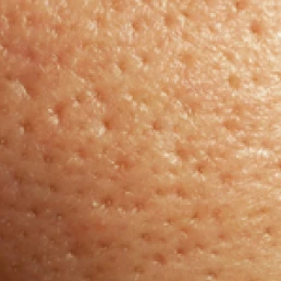 피부_리쥬란S_피부결케어_인포그래픽_르샤인
