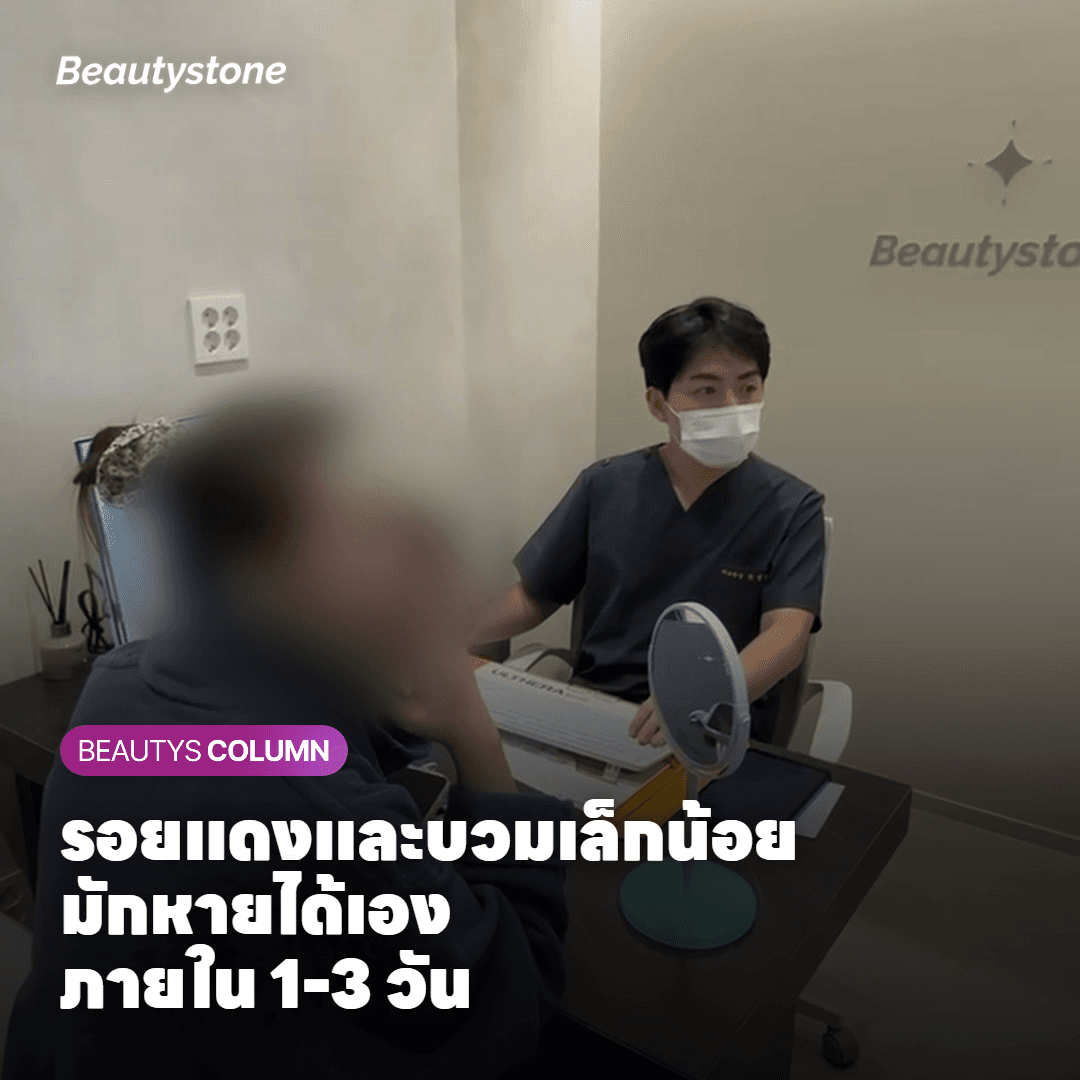 รอยแดงและบวมเล็กน้อยหลังทำ Oligio X ที่มักหายได้เองภายในไม่กี่วัน