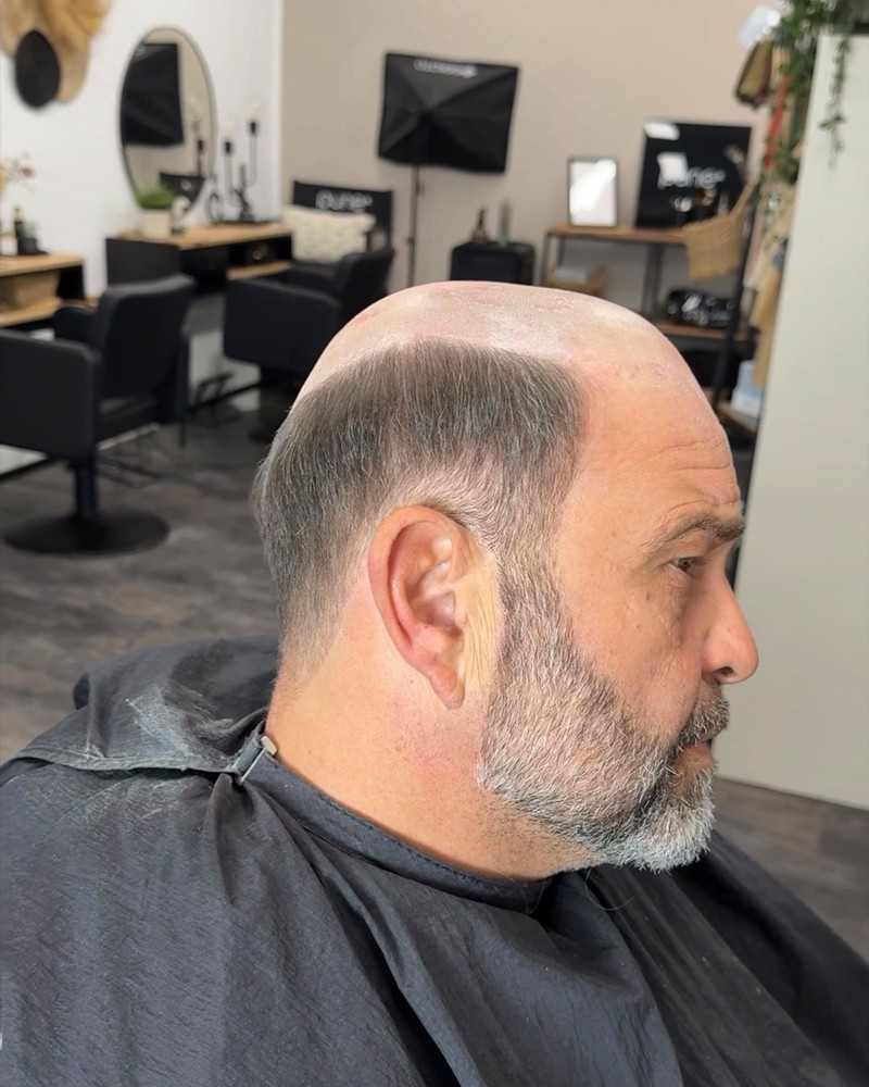 Cortese Haarsysteme - Vorher-Ansicht 5