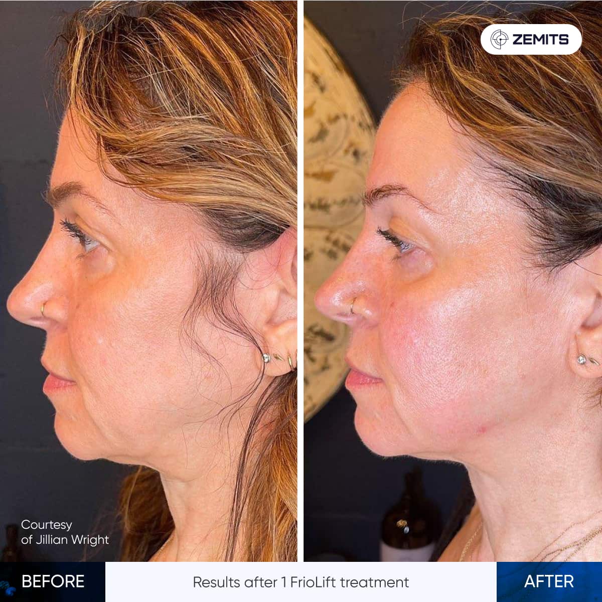 Before and after treatment of a woman's neck and jawline.