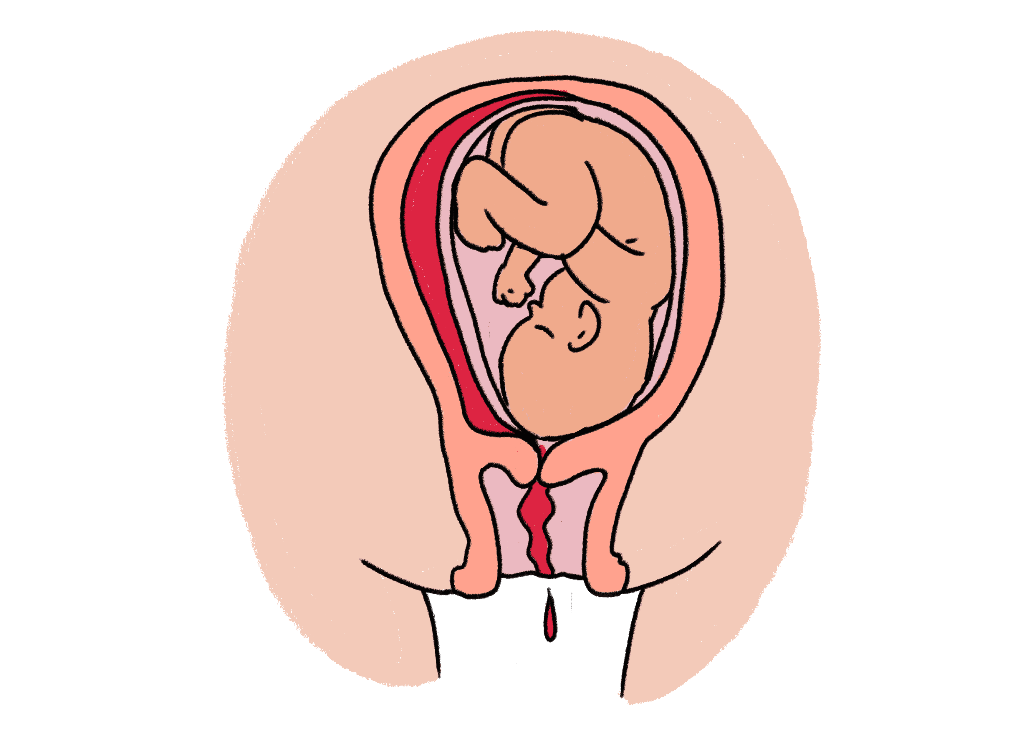 A cross-sectional illustration of a baby in the womb, it is head down. The placenta is shown lying next to the baby and there is a drop of blood coming out of the vagina.