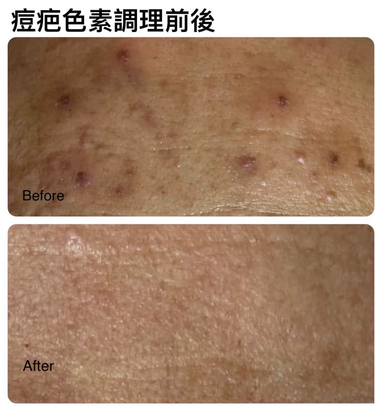 痘疤色素調理前後
