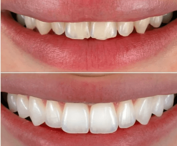 Close-up before and after of a woman’s teeth treated with composite veneers.