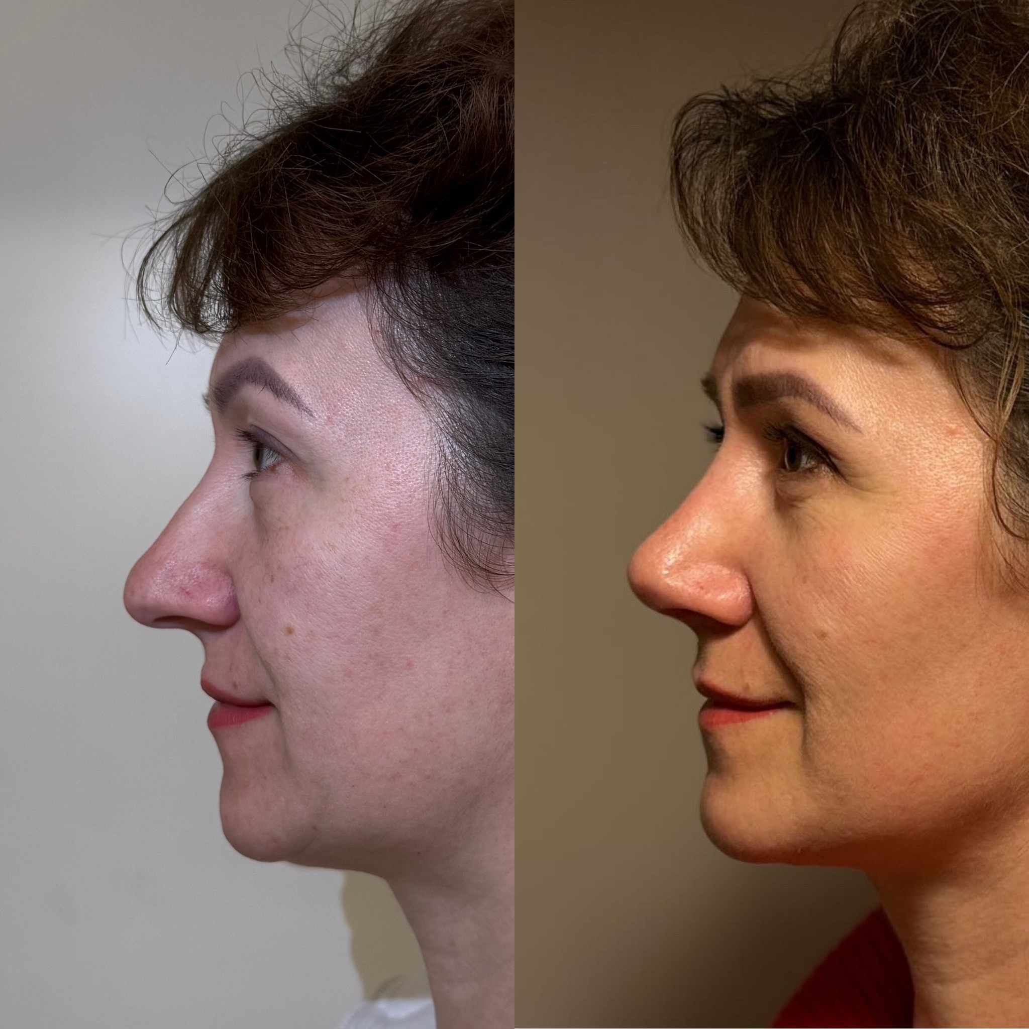 1 month after revision rhinoplasty before after left side view