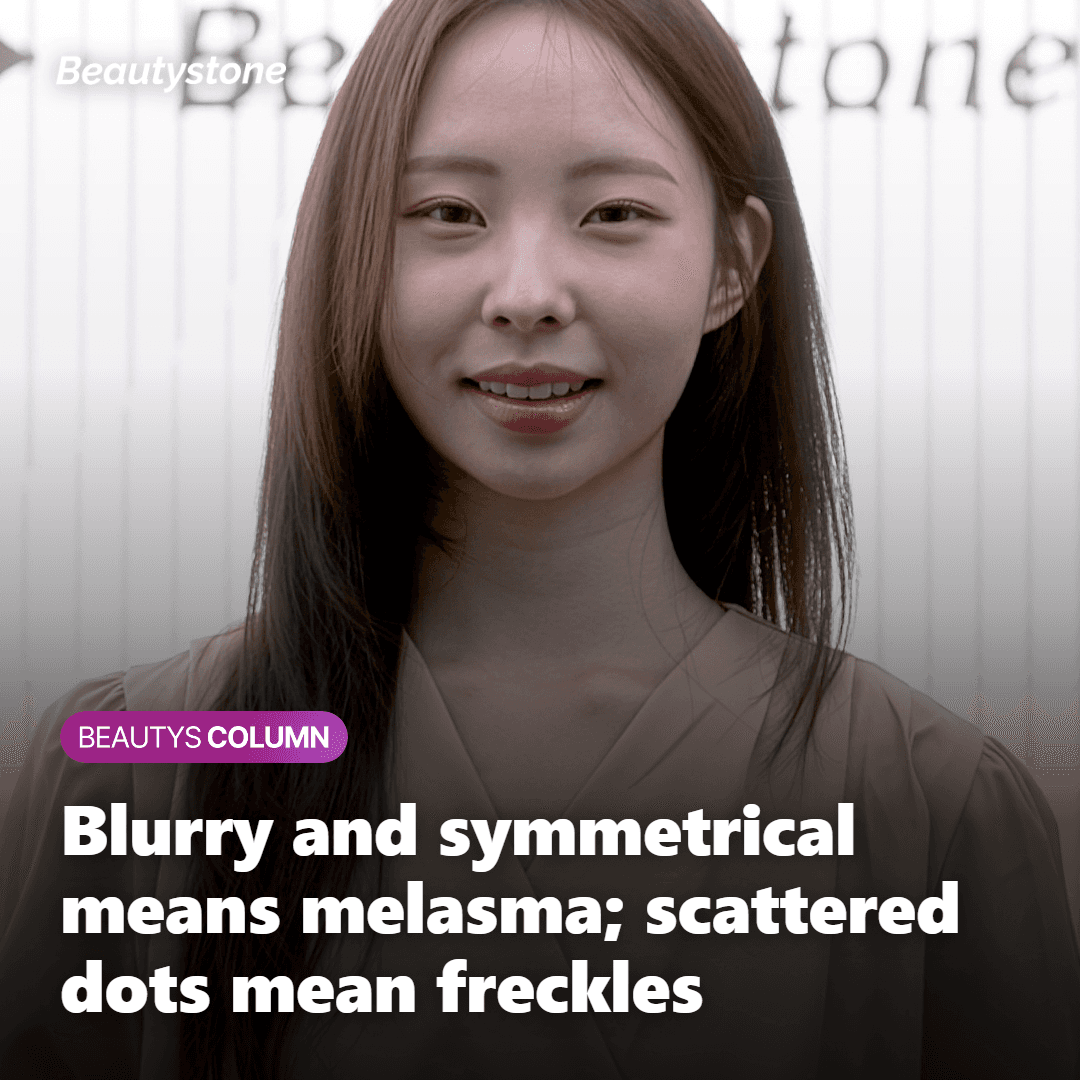 Illustration comparing blurry symmetrical melasma with scattered freckles