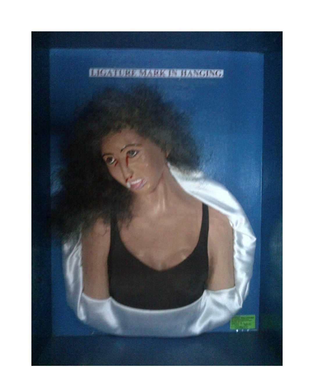 Ligature Mark in Hanging