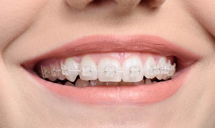 ceramic white braces orthodontics dental