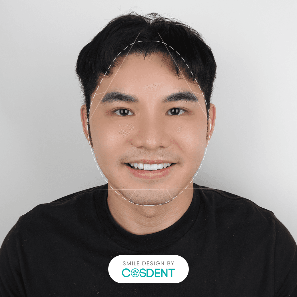 หน้าสามเหลี่ยมกลับหัว ยิ้มกว้าง 18 ซี่