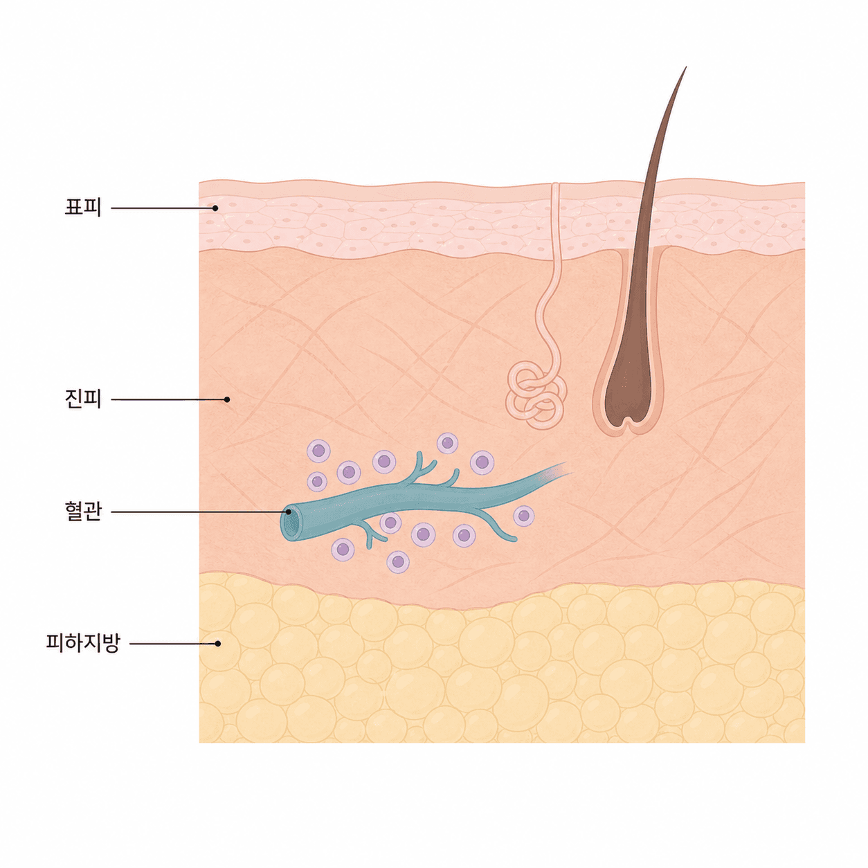감염 반응 중인 피부 층의 상태