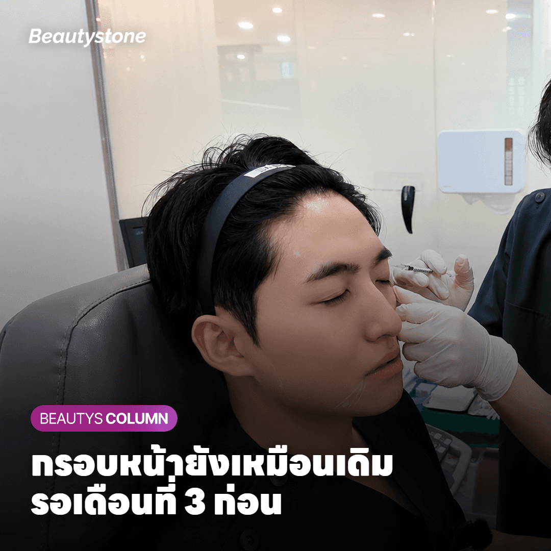 แพทย์ใช้นิ้วดันผิวแก้มล่างขึ้นเบา ๆ เพื่อแยกผิวหย่อนออกจากไขมันใต้คาง
