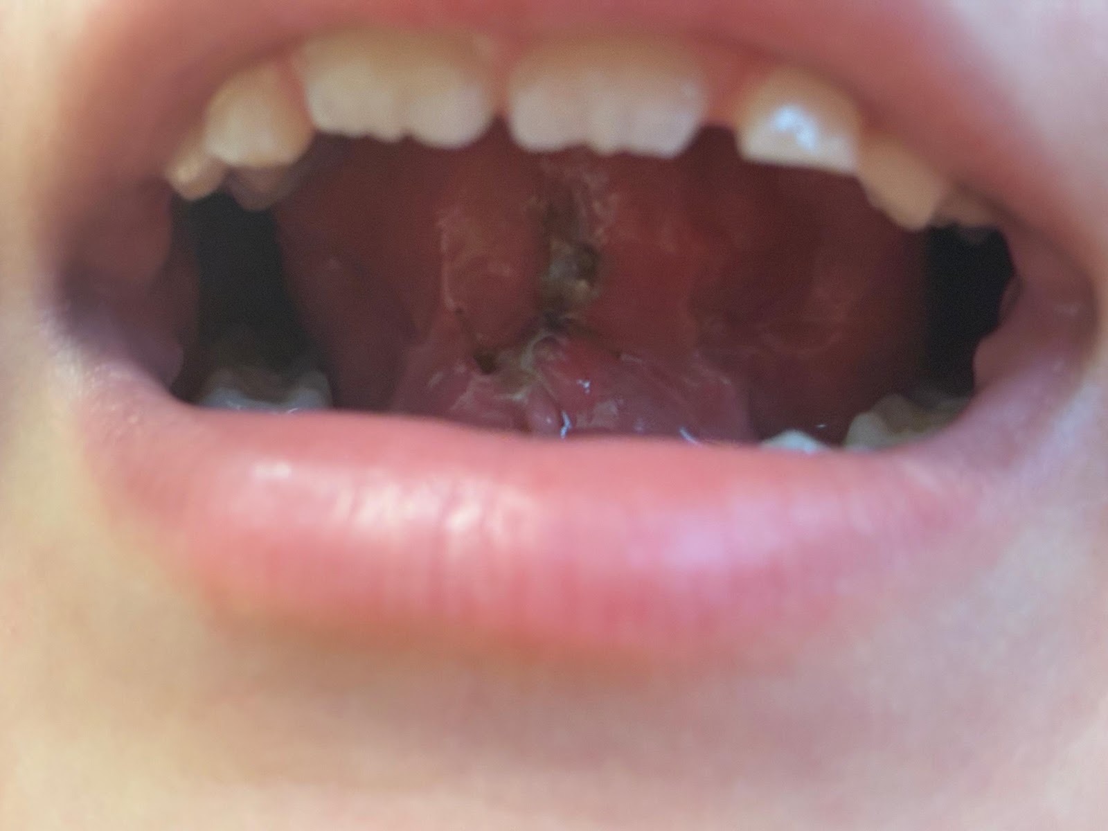 Lengua post cirugía realizada por cirujano maxilofacial.