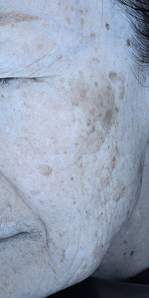 Pigmentation - Before