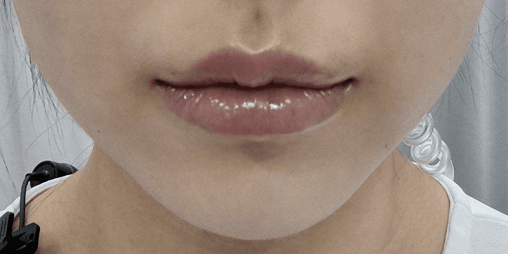 Lip Filler - After