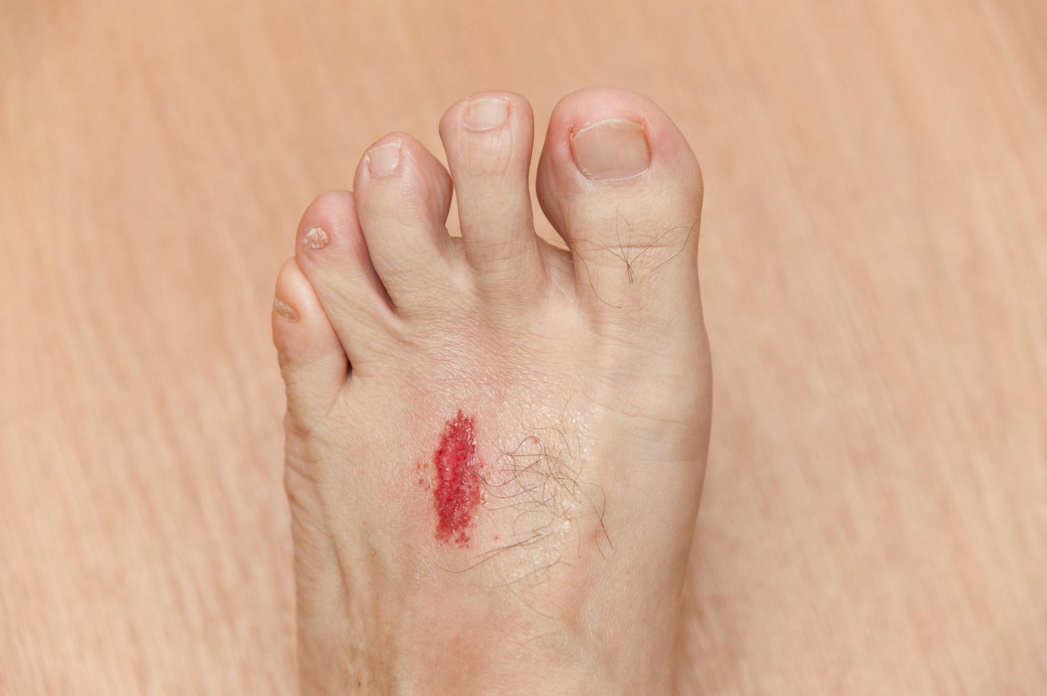 diabetic wound