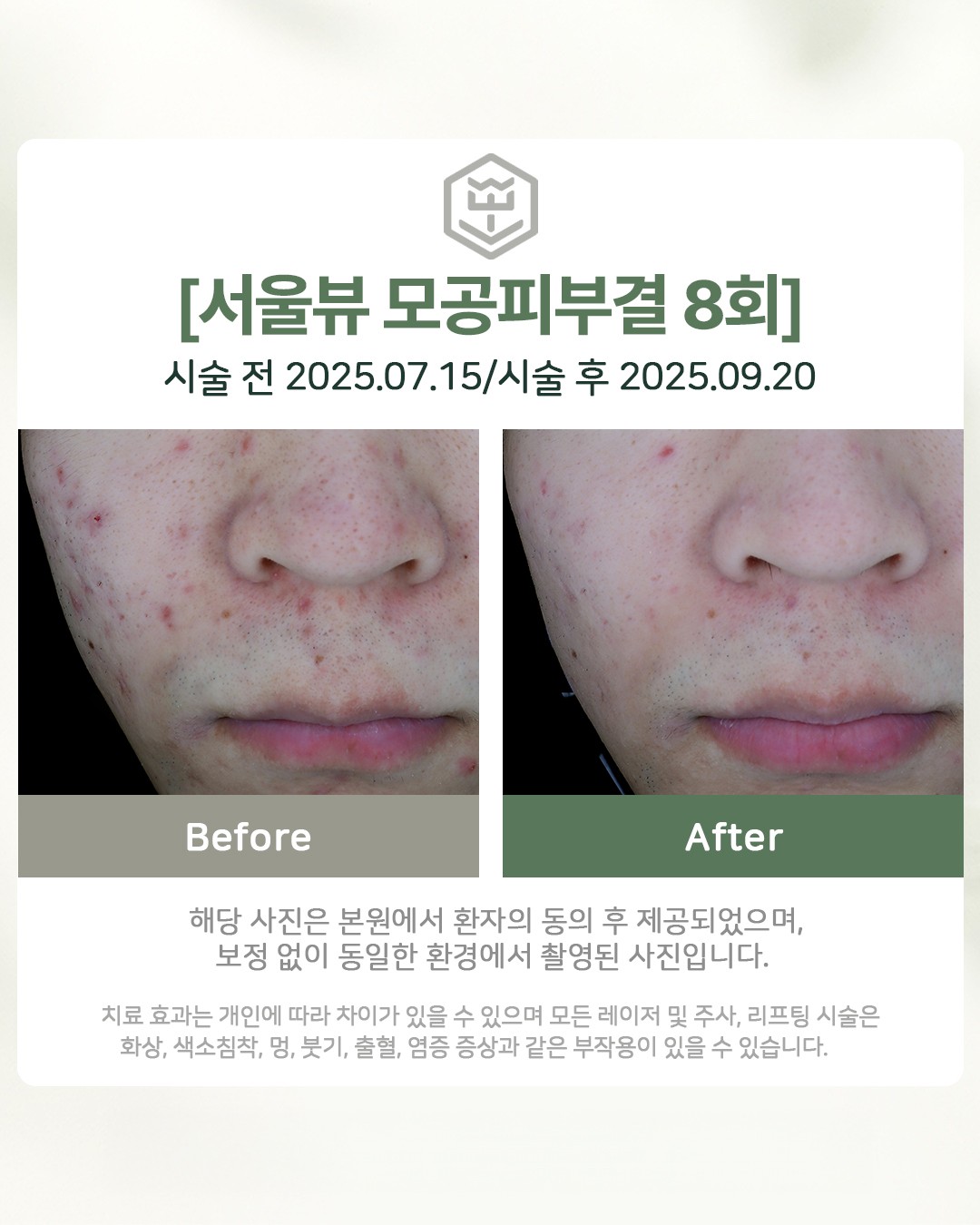 모공피부결 8회