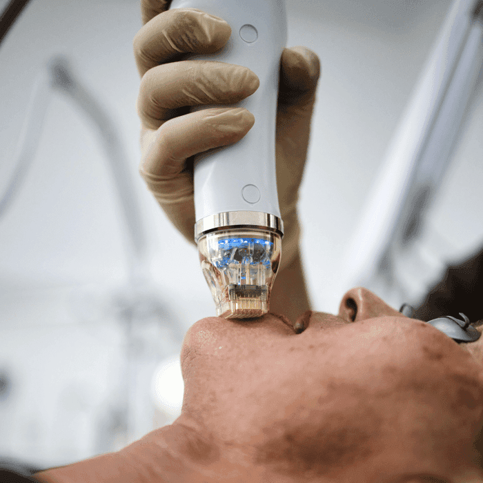 Secret RF Handstück bei der Behandlung im Gesicht – geführte Anwendung