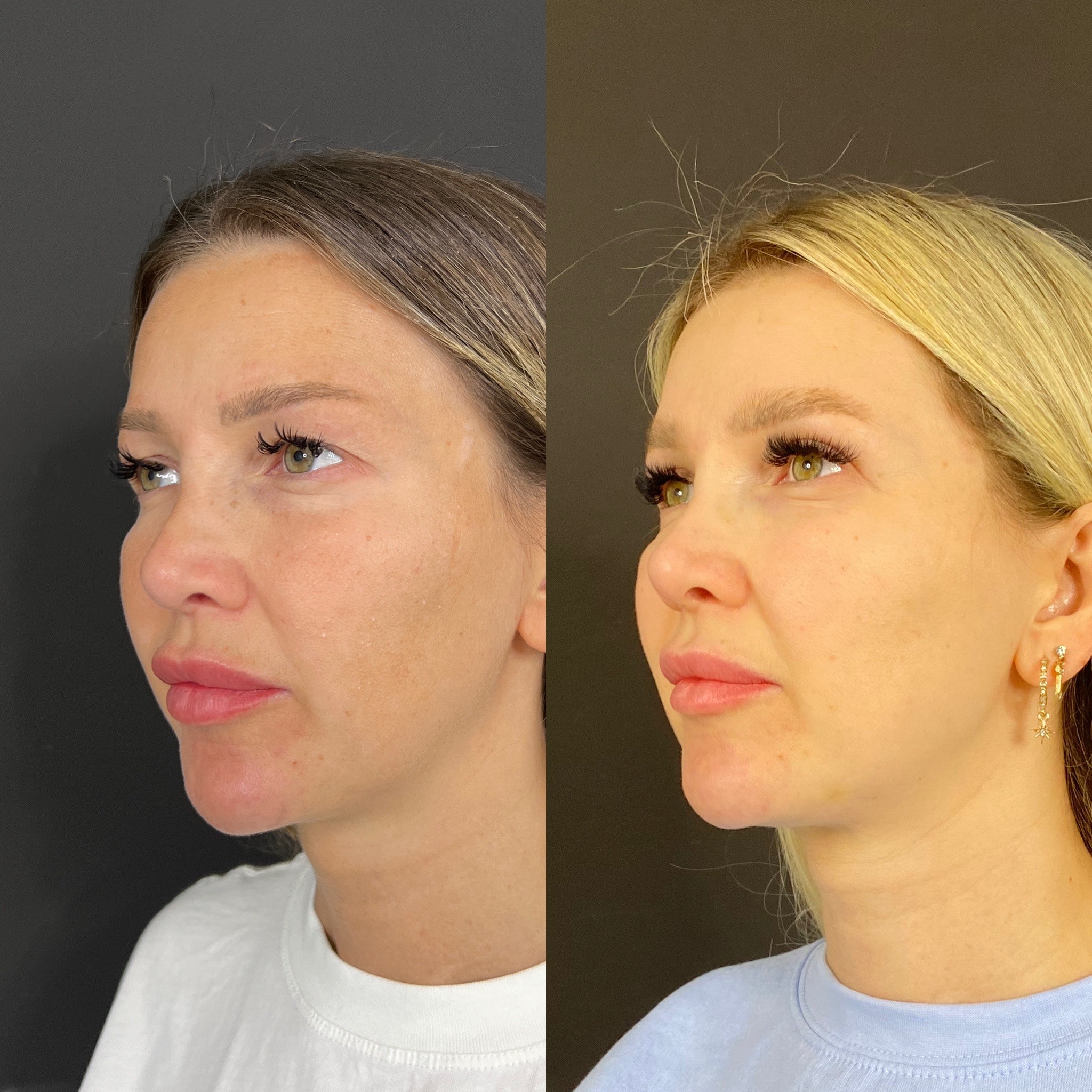 upper blepharoplasty 1 month post op before after