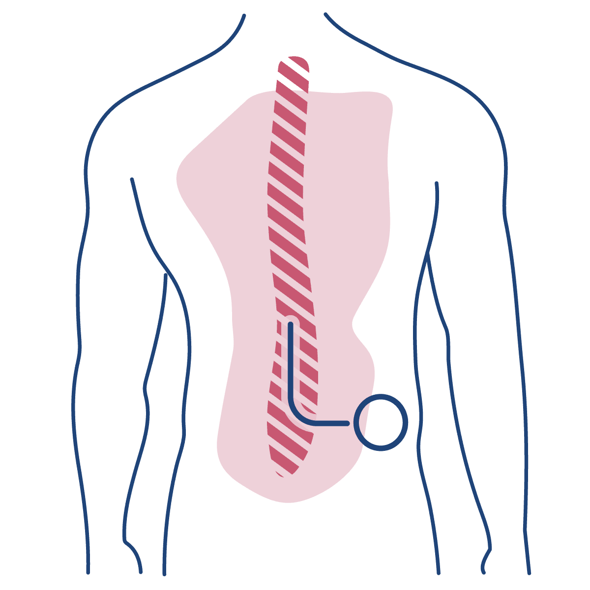 Imagem ilustra homem de costas, desenhado em linhas azuis, com a coluna destaca em rosa escuro destacado, mostrando a bomba de morfina na parte posterior do quadril, ilustrando o tratamento.