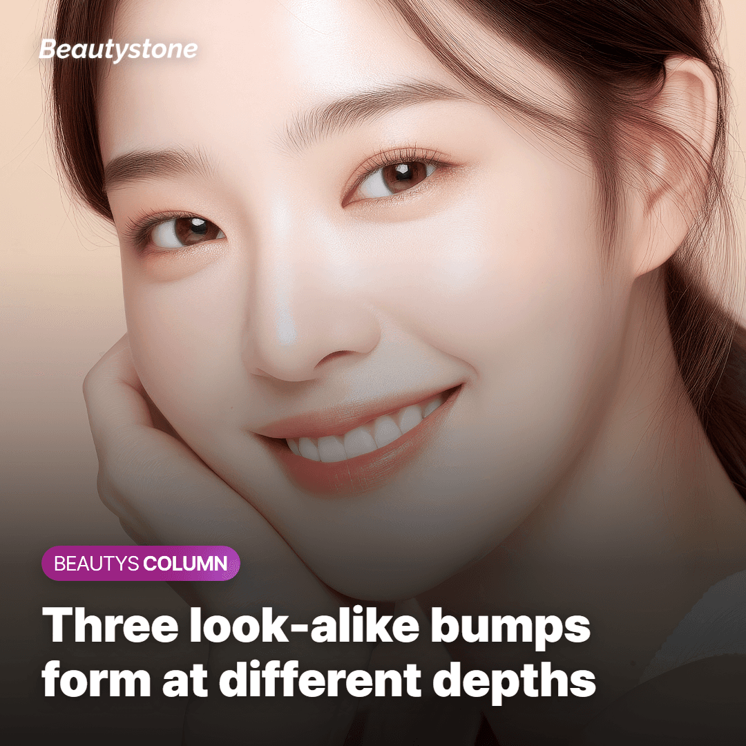 Three tiny bumps — syringoma, milia, and closed comedones — each starting in a different layer of the skin