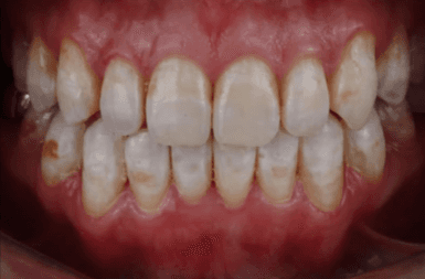 Close-up image of a person's teeth, highlighting white teeth and a discolored tooth requiring a dental crown at Invisalign Center Dubai.