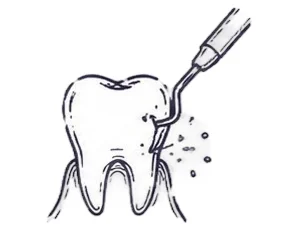 Hand-drawn illustration of dental scaling to remove tartar near the gumline