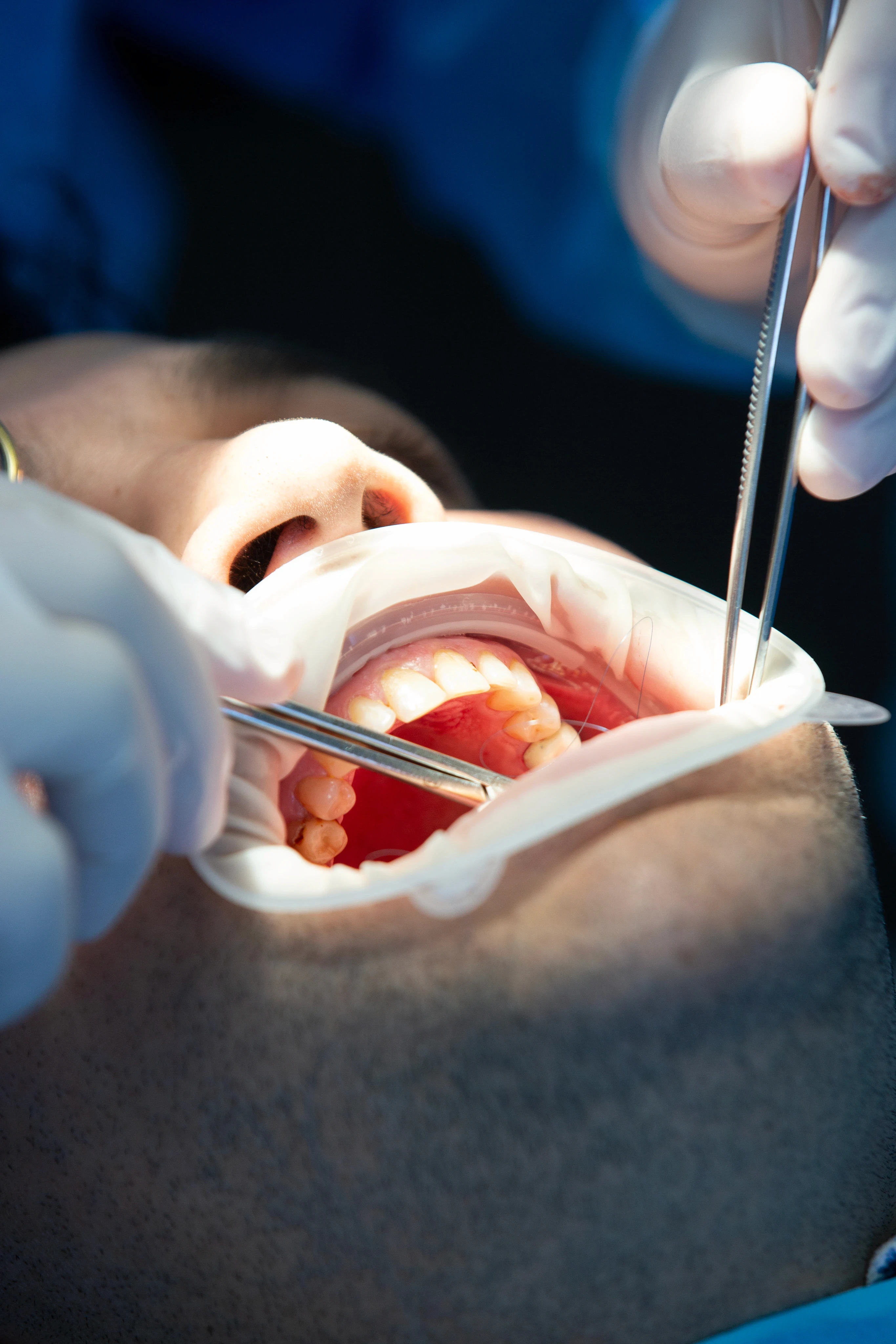 dental implants procedure