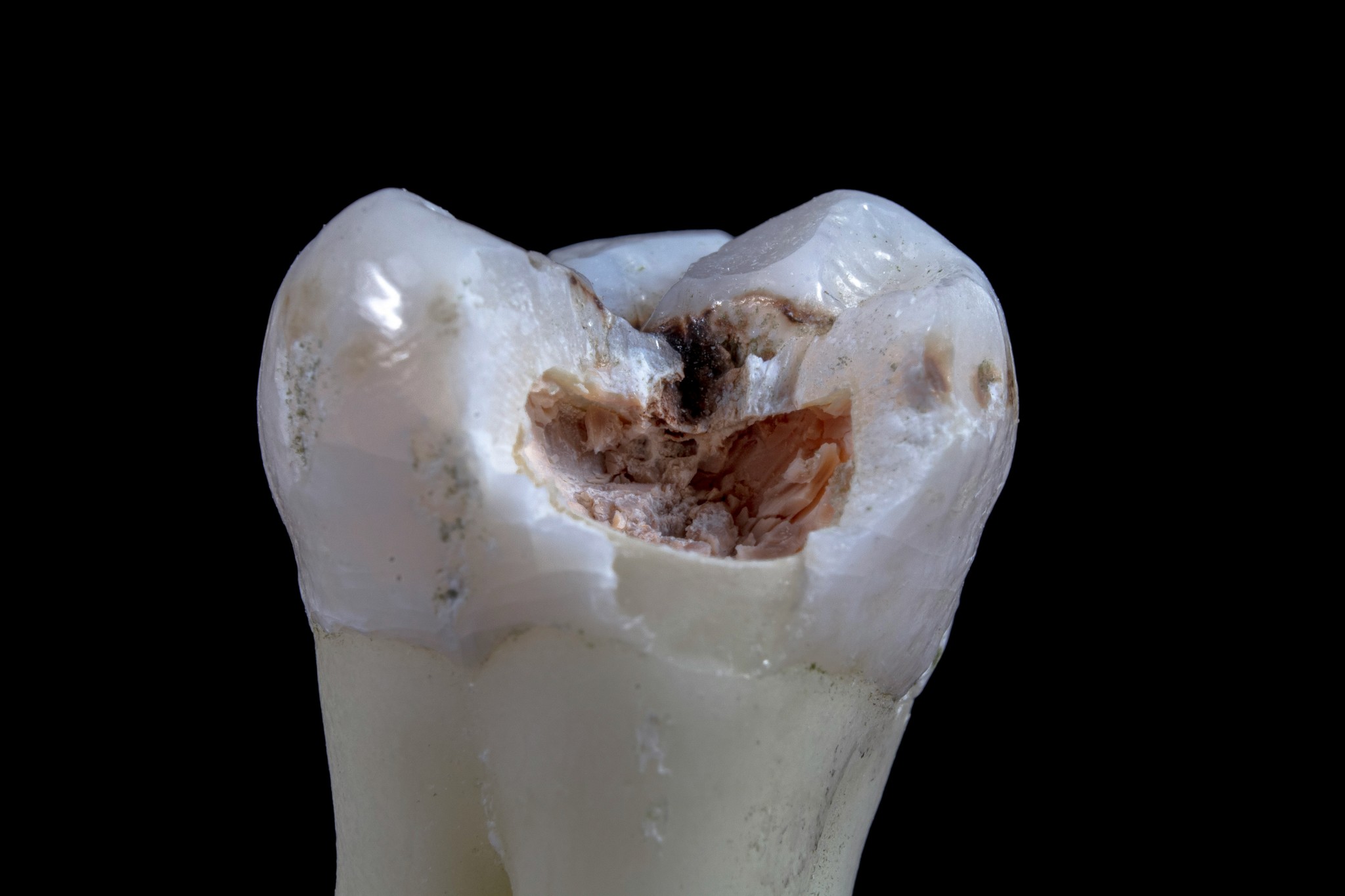 knocked out tooth