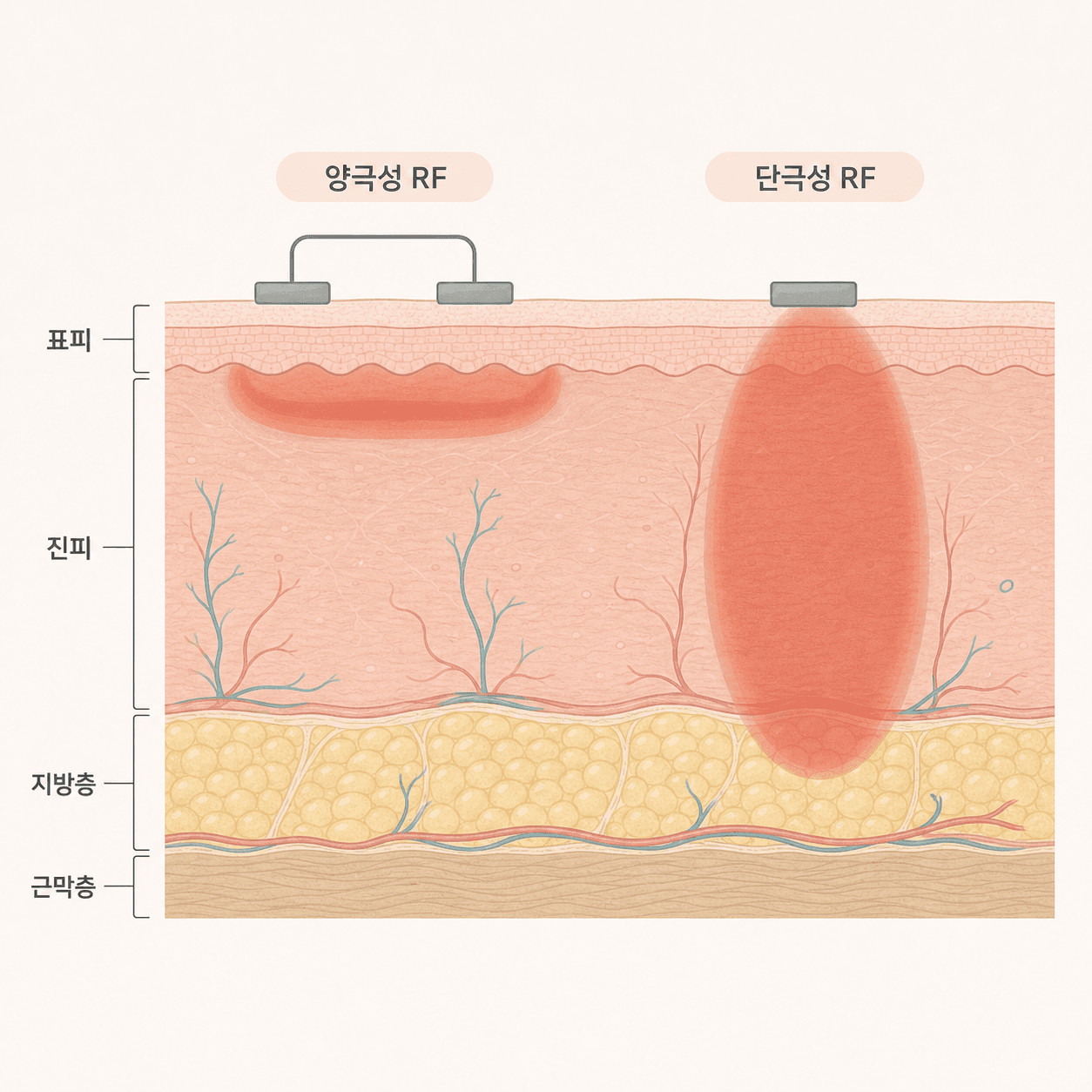 두 전극 사이의 얕은 가열과 진피 전체를 데우는 깊은 가열