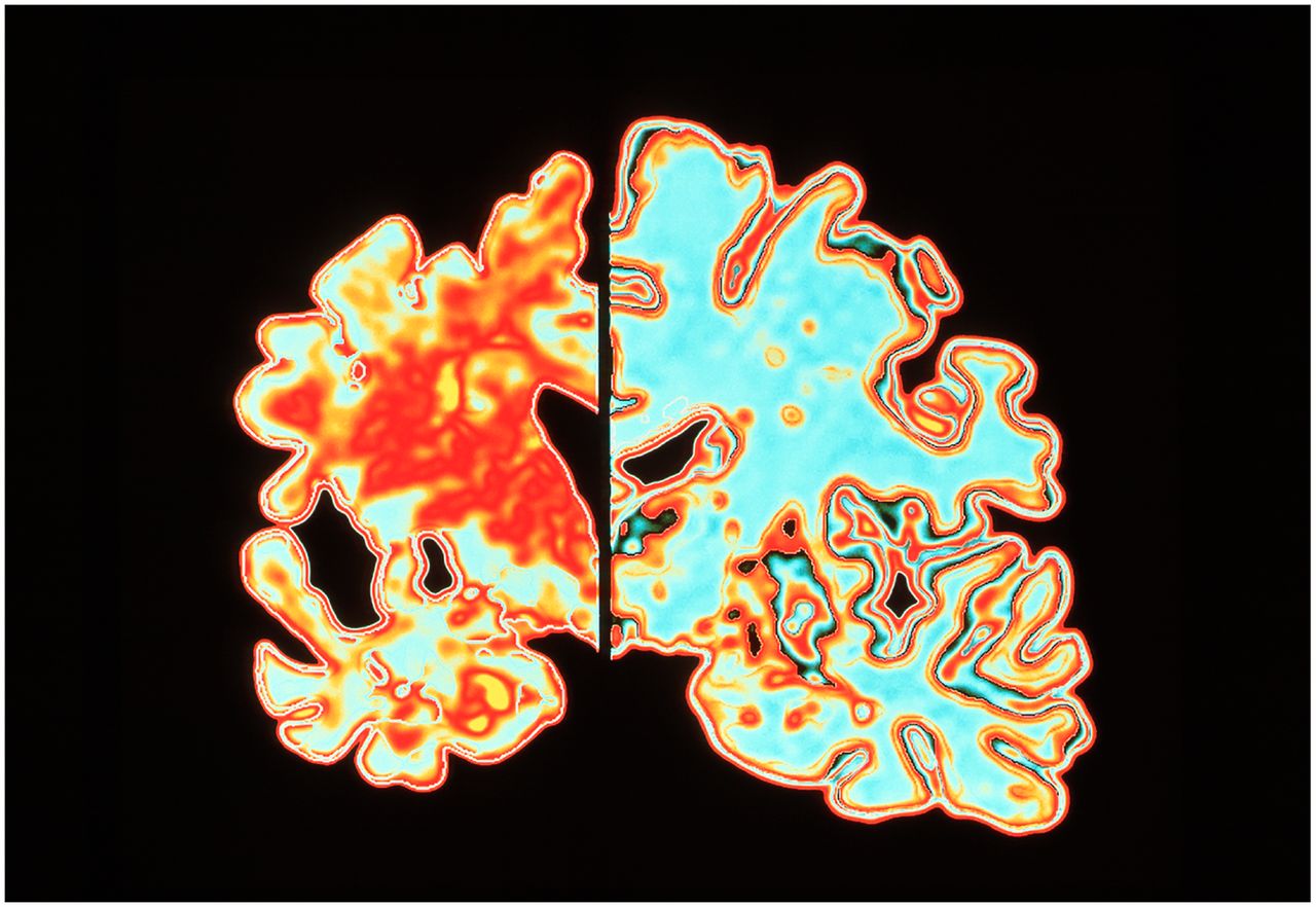 colored image of alzheimer's brain on left and healthy brain on right.