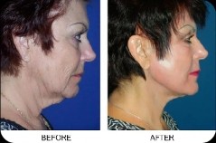 Before and after of surgery image