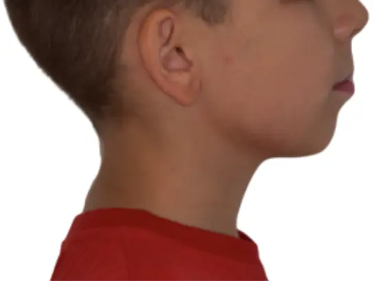 Before and after comparison: Improved jaw line and profile, relaxed smile, muscle tension disappearance, finer posture.