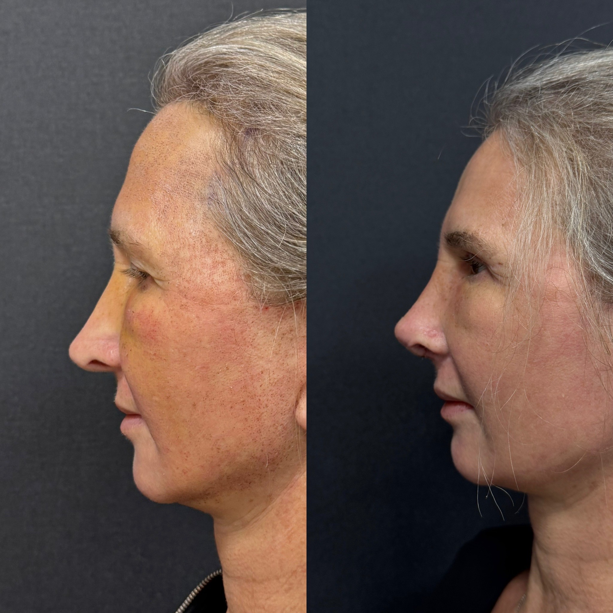 revision rhinoplasty deviation fixed before after 5 days post-op right side view