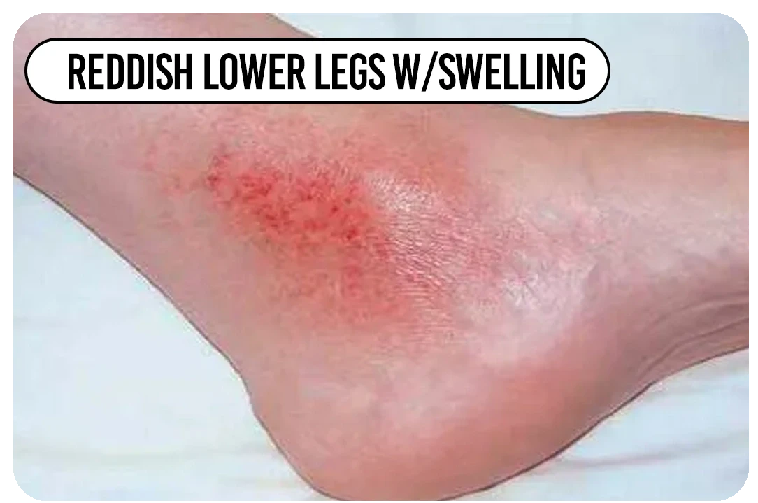 Reddish lower legs w/ swelling