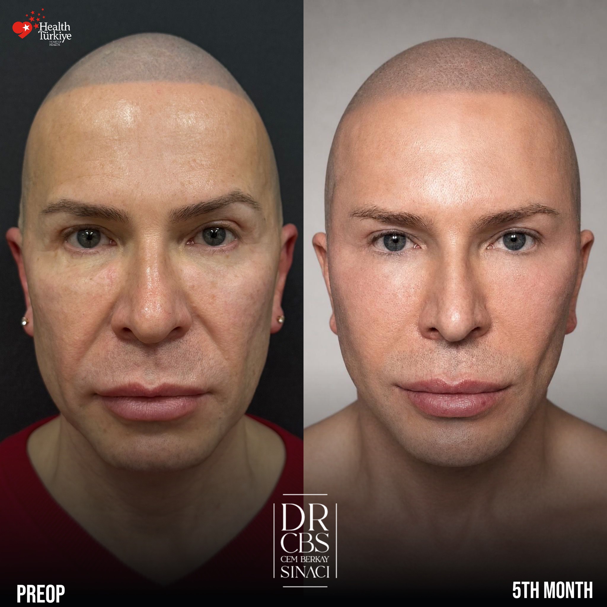 male facelift deep plane before aftter front view